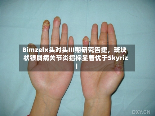 Bimzelx头对头III期研究告捷，斑块状银屑病关节炎指标显著优于Skyrizi