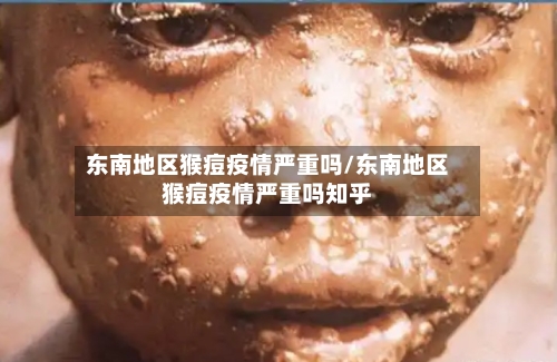 东南地区猴痘疫情严重吗/东南地区猴痘疫情严重吗知乎